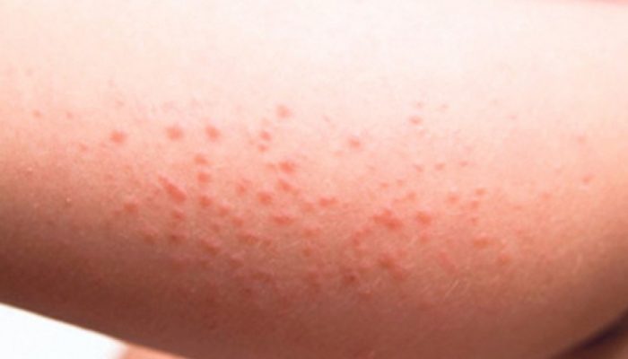 Как проявляется и чем лечится аллергия на солнце? Лучшие лекарства для детей и взрослых