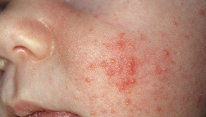 Почему возникает цветение кожи у новорожденных? Правила ухода и отличие от аллергии