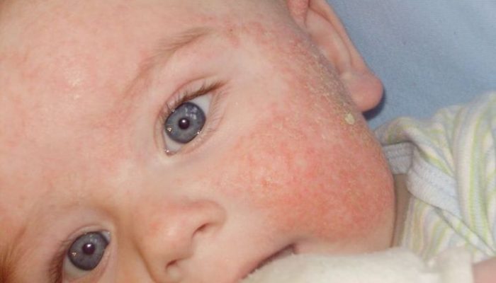 Что делать, если у ребенка диатез на щеках? Требуется ли лечение?