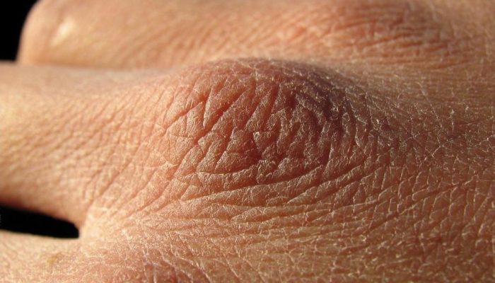 Сильное шелушение кожи тела: причины и лечение