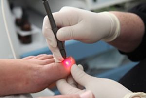 Лазерное лечение грибка ногтей: цена и отзывы