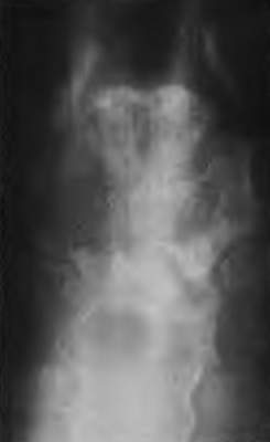 Поражение грудины при неходжкинской лимфоме (фото)