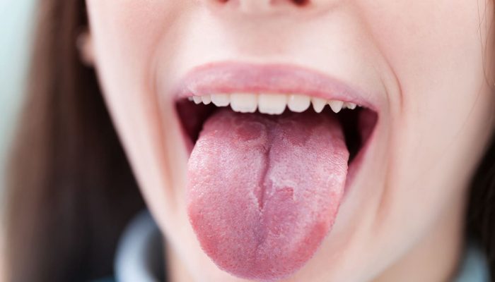 Как проявляется ожог слизистой полости рта? Способы лечения