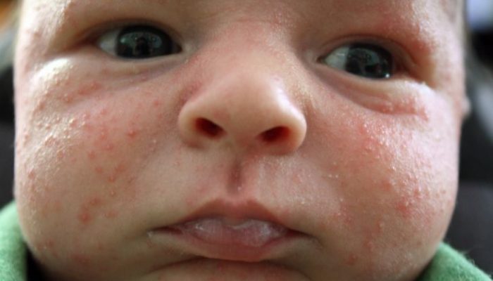 Почему возникает цветение кожи у новорожденных? Правила ухода и отличие от аллергии