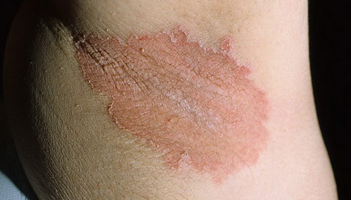 Причины, симптомы и лечение кандидоза кожи, а также терапия кандидосепсиса