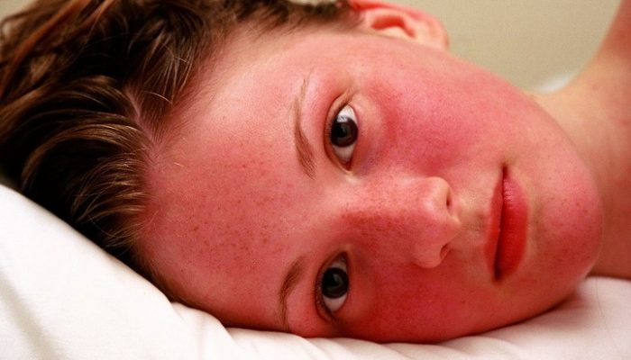 Выясняем, почему краснеет лицо? Как распознать болезнь и проводить лечение?