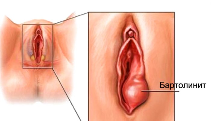 Почему возникают прыщи на половых губах и других участках интимной зоны? Правильная диагностика