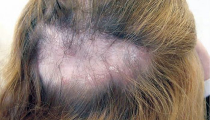 Диффузное телогеновое выпадение волос у женщин