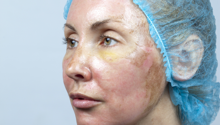 Уход за кожей лица после химического (желтого) и лазерно пилинга: практические рекомендации