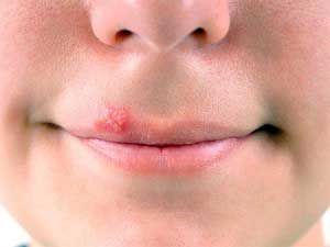 Причины возникновения герпеса на губе