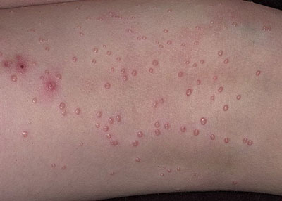 Вирусное кожное заболевание в виде множественных округлых высыпаний
