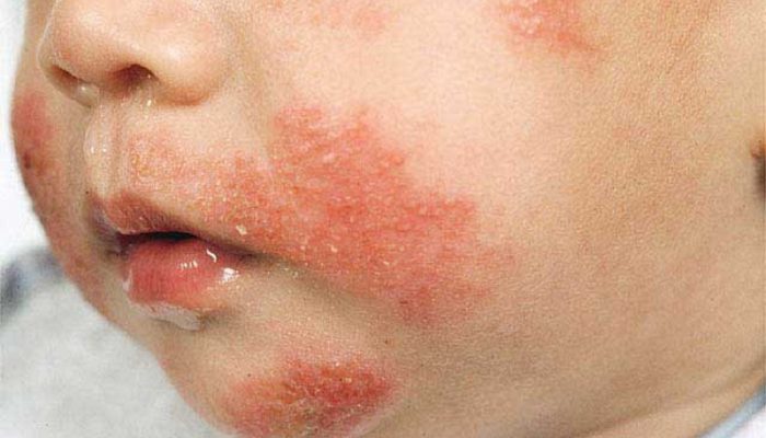 Как проявляется пищевая аллергия?