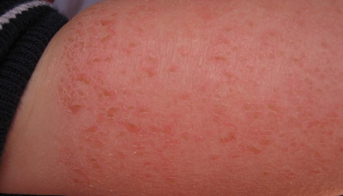 Бывает ли аллергия на творог? Каковы симптомы и лечение?