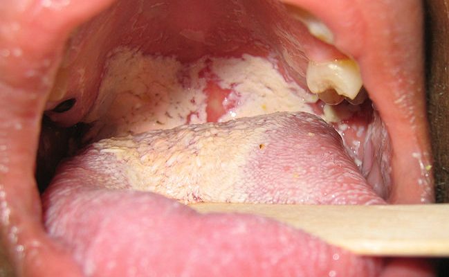 Что такое кандидоз горла? Причины, симптомы и методы лечения инфекции