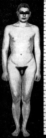 Синдром Клайнфельтера (фото): оволосение в области лобка по женскому типу