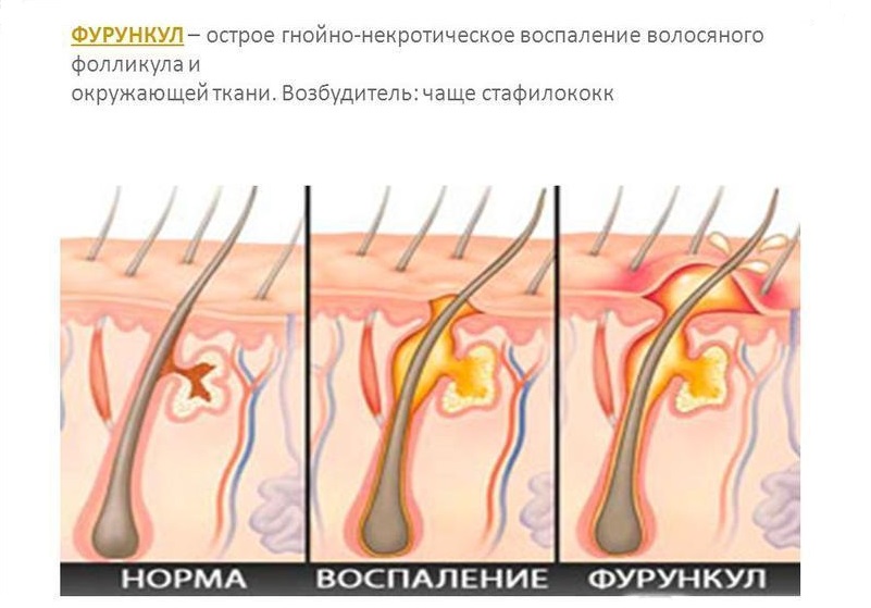 Как удалить фурункул?