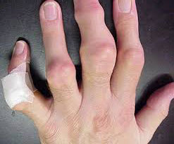 Уплотнения кожи на большом пальце руки thumbnail