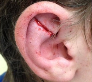 Травмированные части ушей