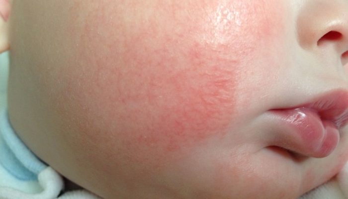 Аллергия на кефир и кисломолочные продукты у ребенка