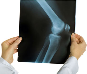 Артрозо артрит коленного сустава: диагностика