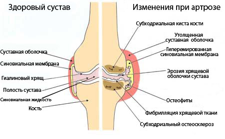 Степени артрозо артрита коленного сустава