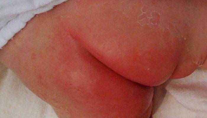Применение цинковой мази при лечении кожи у детей