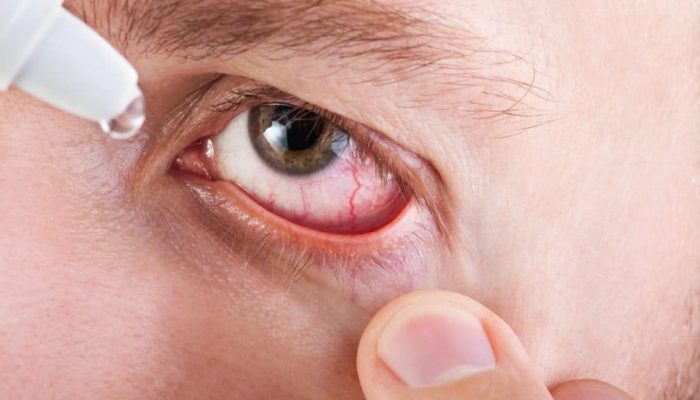 Как распознать и лечить грибок на глазах и веках? Лучшие медикаментозные и народные средства