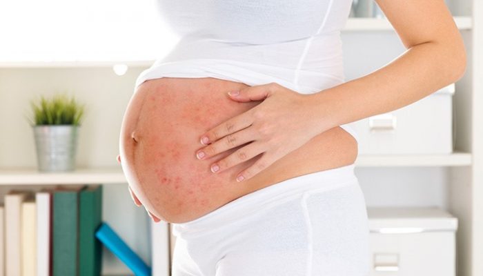 Особенности течения и терапии псориаза при беременности: самая важная информация для пациента