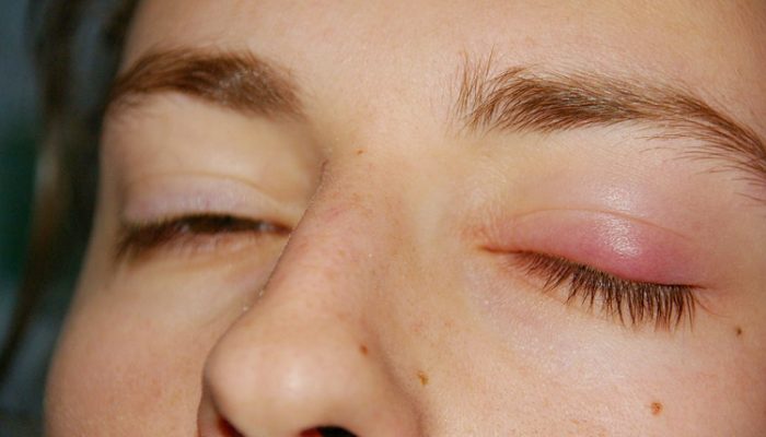 Аллергический отек глаза: что делать?