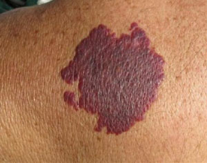 Причины винных и фиолетовых пятен на коже