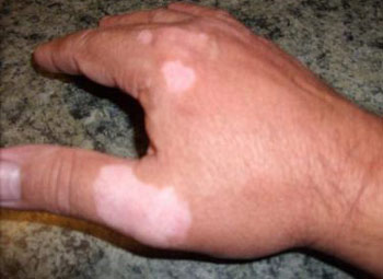Белые изменения на коже руки thumbnail