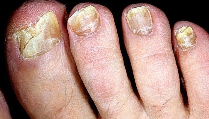 Лечение грибка ногтей борной кислотой