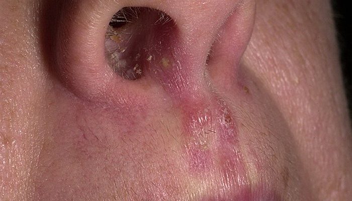 Как проявляется грибок в носу? Лечение болезни таблетками и местными средствами