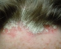 Себорейный дерматит волосистой части головы: причины и лечение