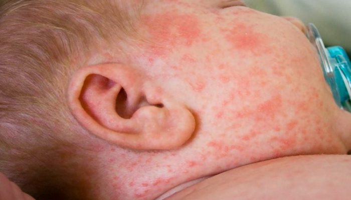 Аллергические пятна на лице у ребенка фото
