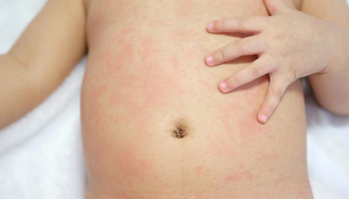 Почему возникла сыпь на теле у ребенка? Виды высыпаний и возможные причины