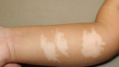 Белые пятна на коже рук могут появляться по причине витилиго