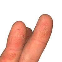 Причины появления трещин на пальцах рук