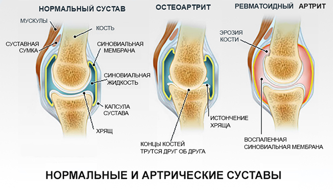 стадии ревматоидного артрита 