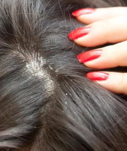 Симптомы и лечение сухой себореи кожи головы