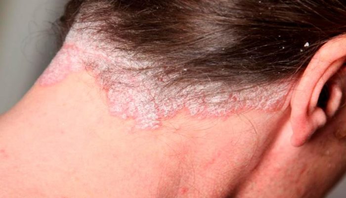 Себорея волосистой части головы: методы лечения