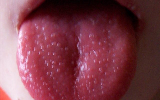 Аллергия во рту: признаки и лечение