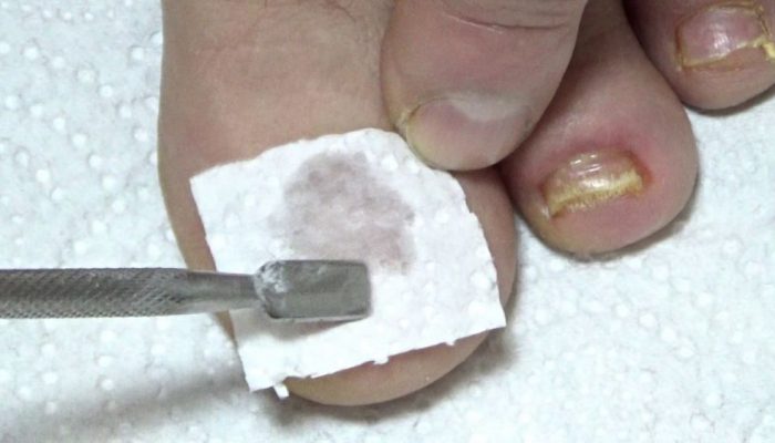 Как распарить ногти на ногах при грибке?