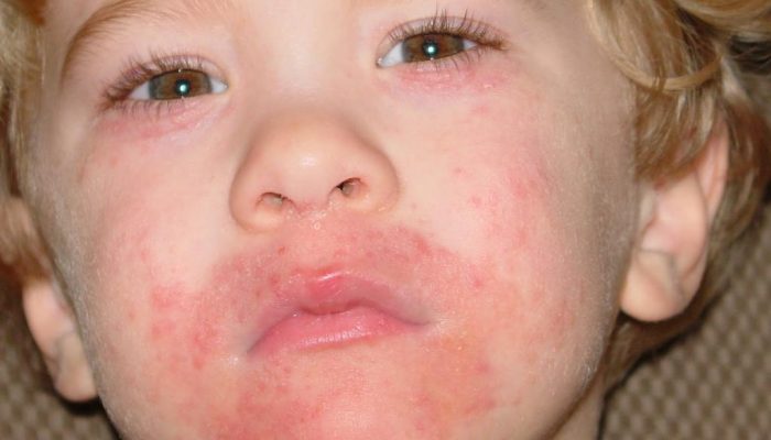 Как выглядит и лечится дерматит на лице? Полезные советы