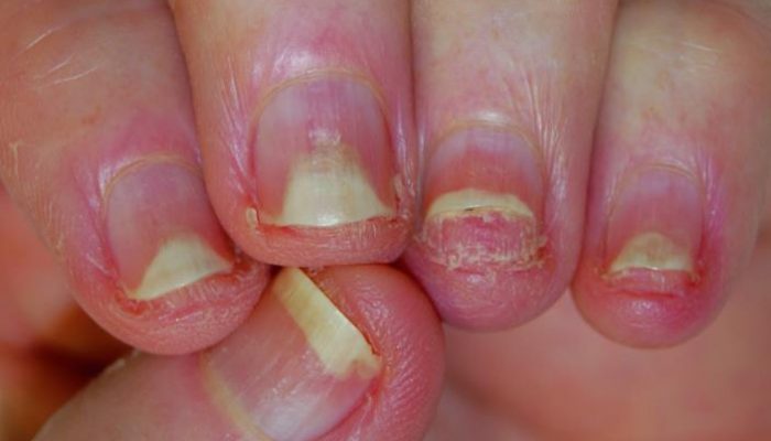 Что такое псориаз ногтей? Причины, симптомы и лечебная тактика