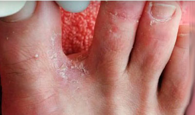 Возможные причины покраснения и зуда между пальцами ног
