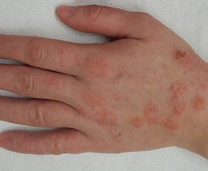 Аллергические красные пятна на коже рук