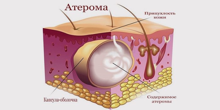 Атерома у новорожденного на голове и мошонке