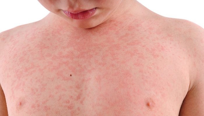 Симптомы и лечение аллергии на лекарства: как избавиться от проявлений непереносимости?