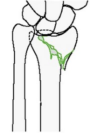 Неполный внутрисуставной сагиттальный перелом лучевой кости